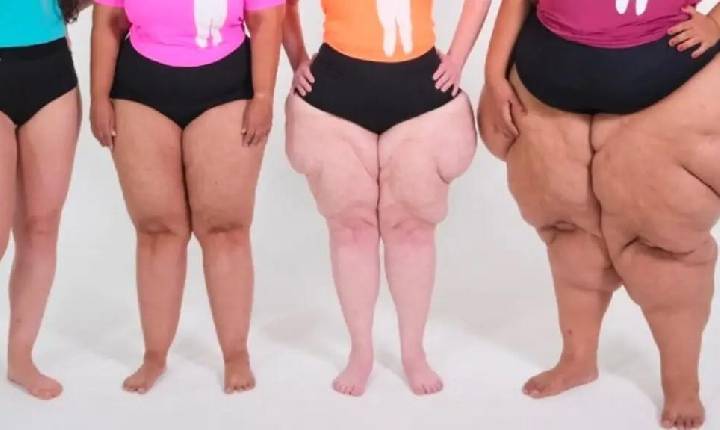Evento em Paulínia domingo orienta população sobre lipedema e promove acolhimento