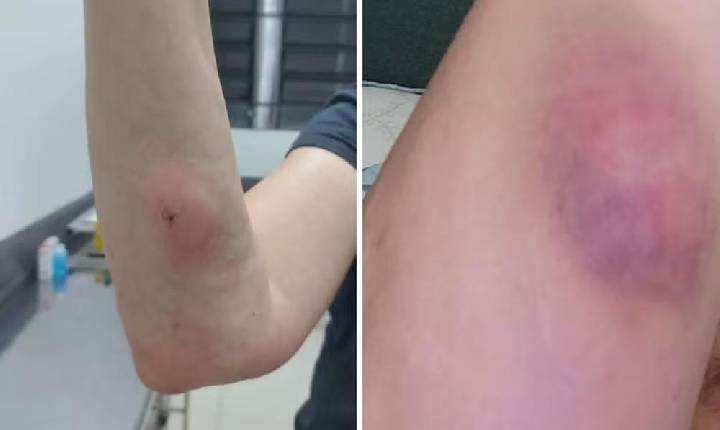 Mulher processa clínica veterinária após receber no braço injeção que deveria ser aplicada em cachorra