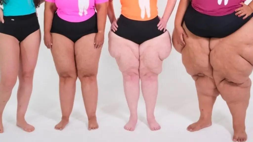 Evento em Paulínia domingo orienta população sobre lipedema e promove acolhimento